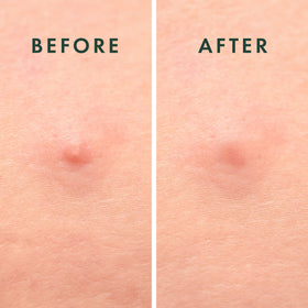 Rael Hydrocolloid Pimple Patch showing strong adhesive