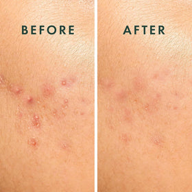 Rael Hydrocolloid Pimple Patches in a skincare routine