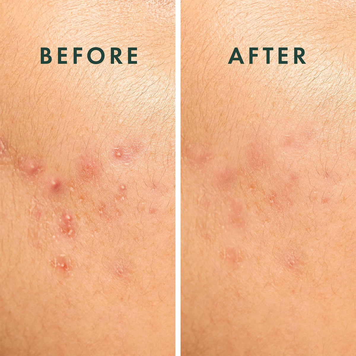 Rael Miracle Spot Control Hydrocolloid Strips in use