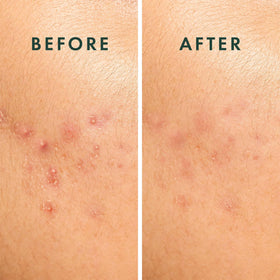 Rael Miracle Spot Control Hydrocolloid Strips in use