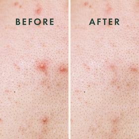 Rael Miracle XL Hydrocolloid Pimple Patch on skin