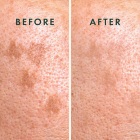 Rael patches in use on a skin surface