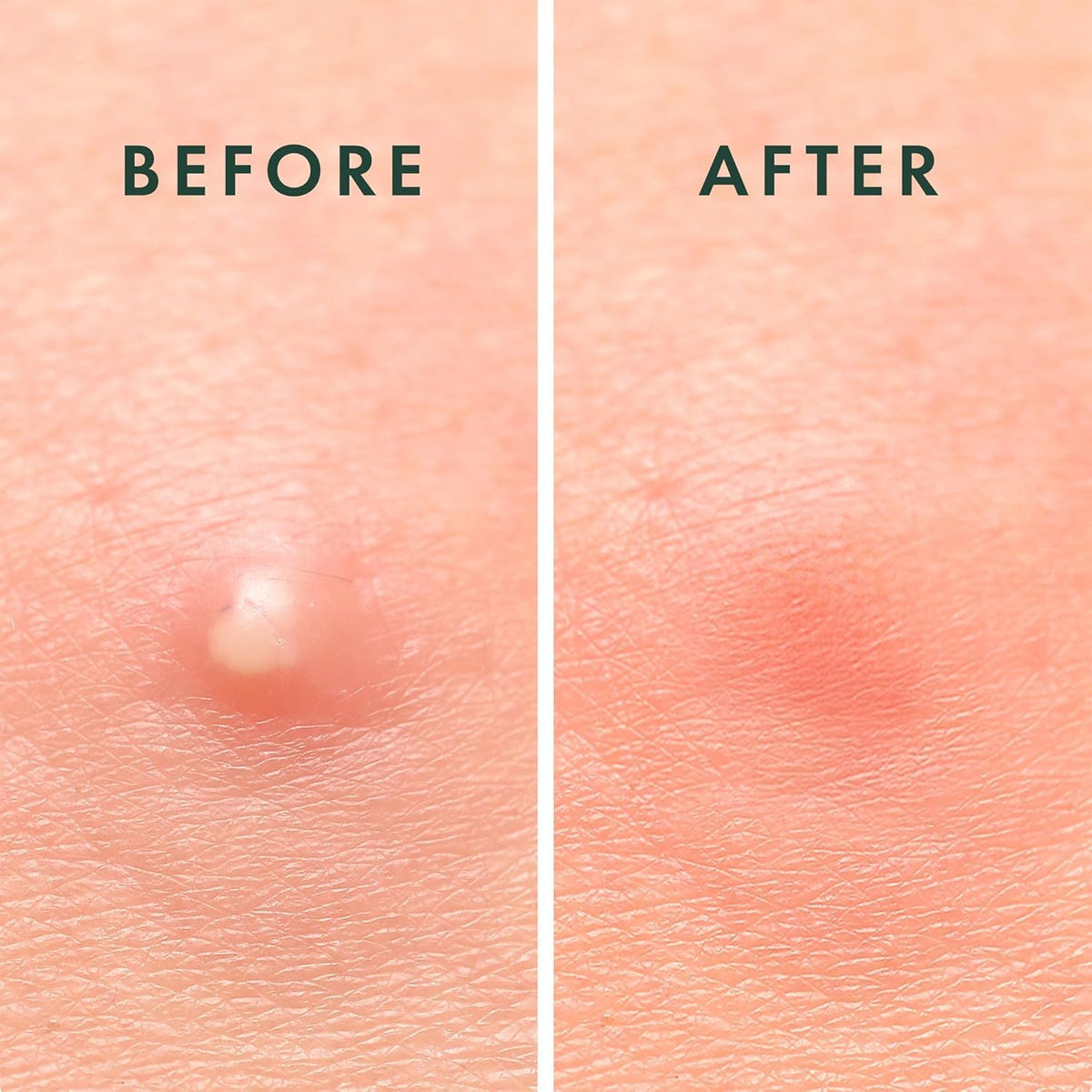 Rael Pimple Patches box with product details