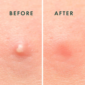 Rael Pimple Patches box with product details