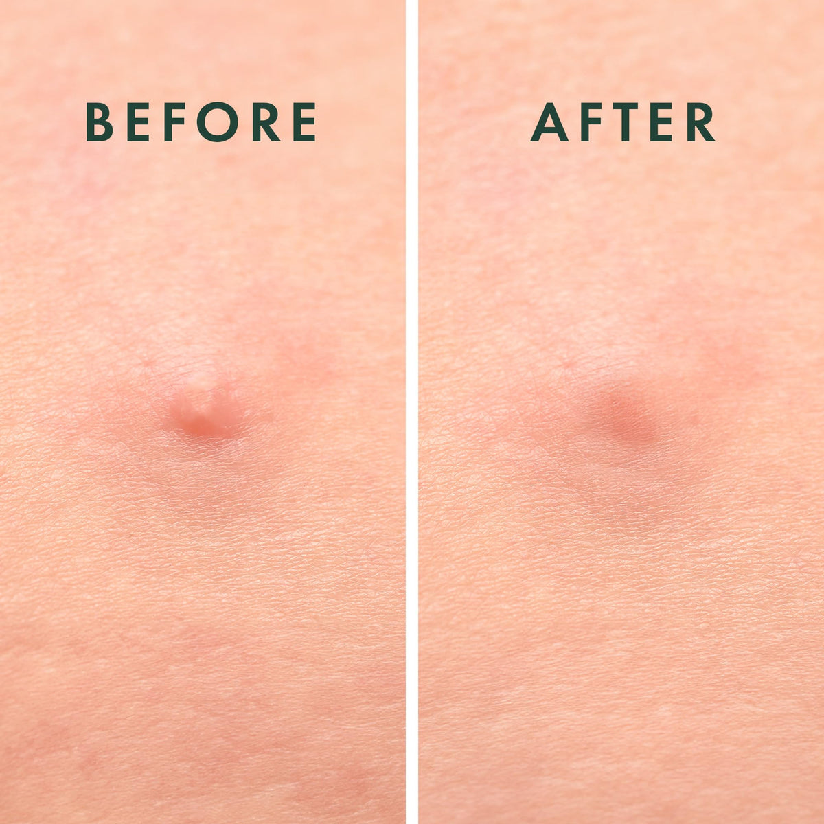 Rael Pimple Patches with ingredients list