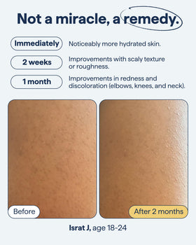 Remedy Science KP Body Moisturizer 259g packaging details