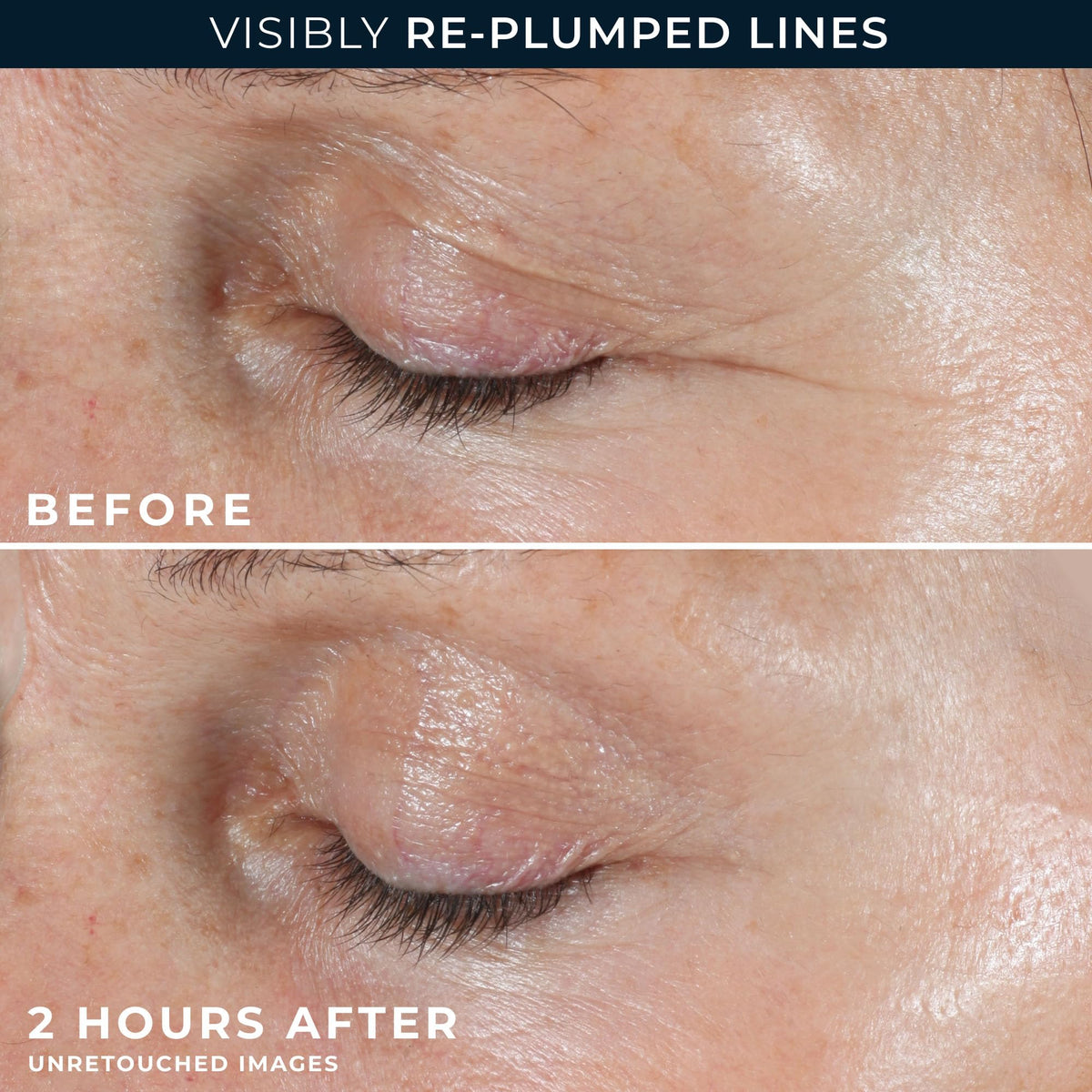 RoC Retinol Correxion Forehead Wrinkle Patches with ingredients list
