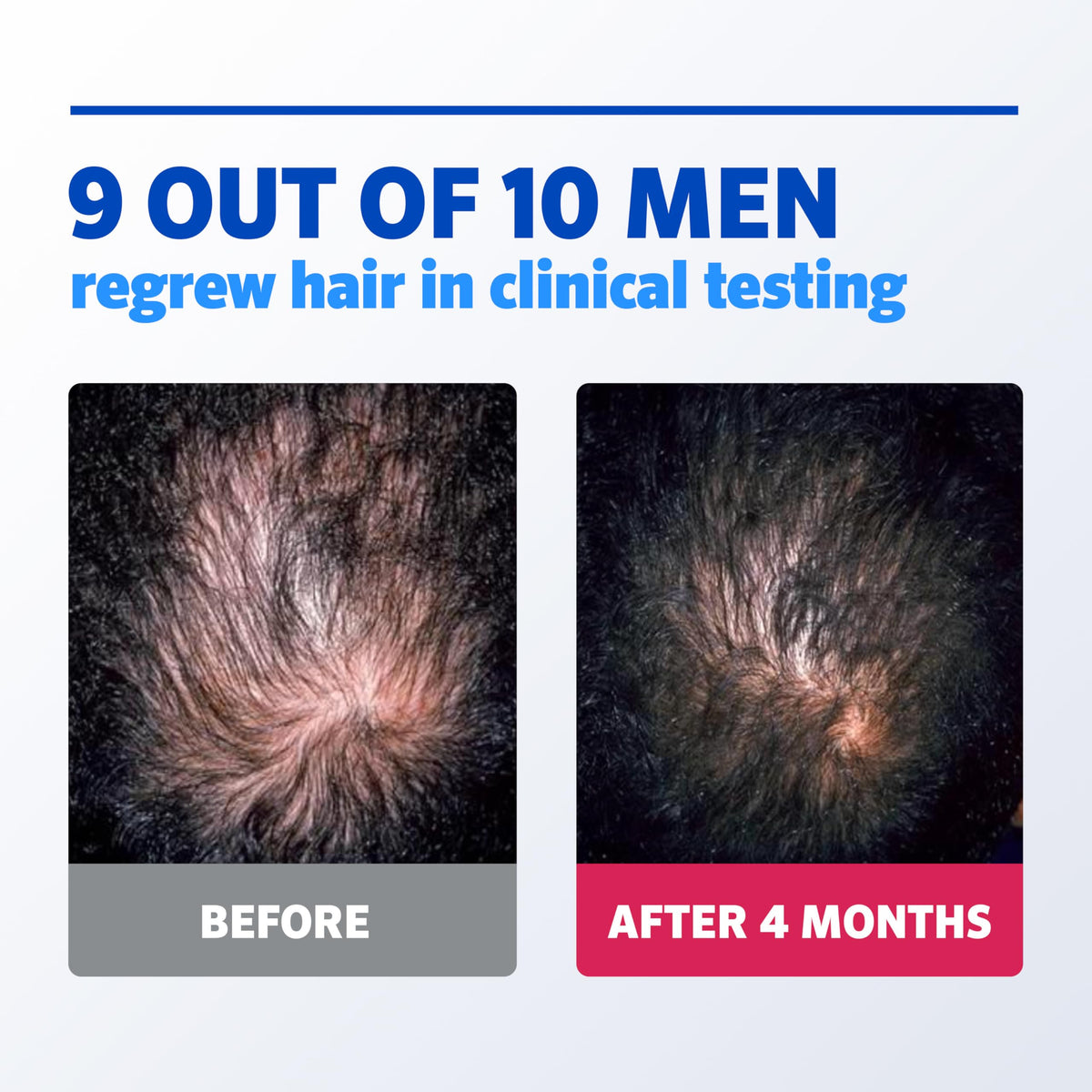Rogaine Men's 5% Minoxidil Foam with measuring cap