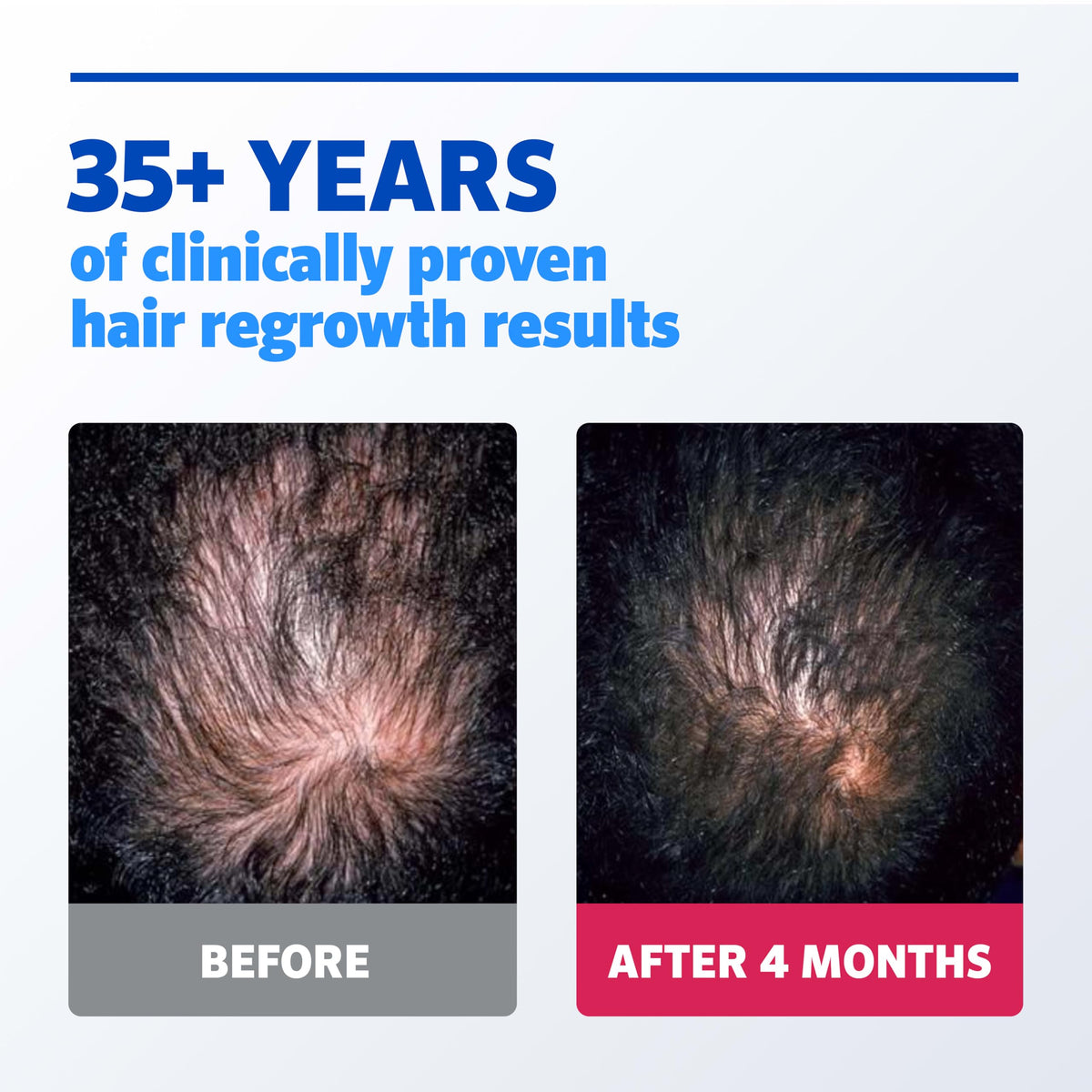Rogaine Men's Hair Regrowth 5% Minoxidil Solution packaging details