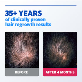 Rogaine Men's Hair Regrowth 5% Minoxidil Solution packaging details