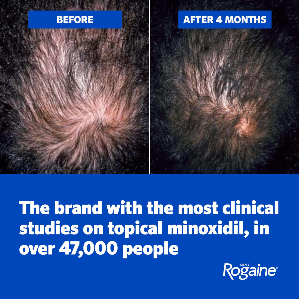 Rogaine Men's Hair Regrowth Foam 5% Minoxidil application process