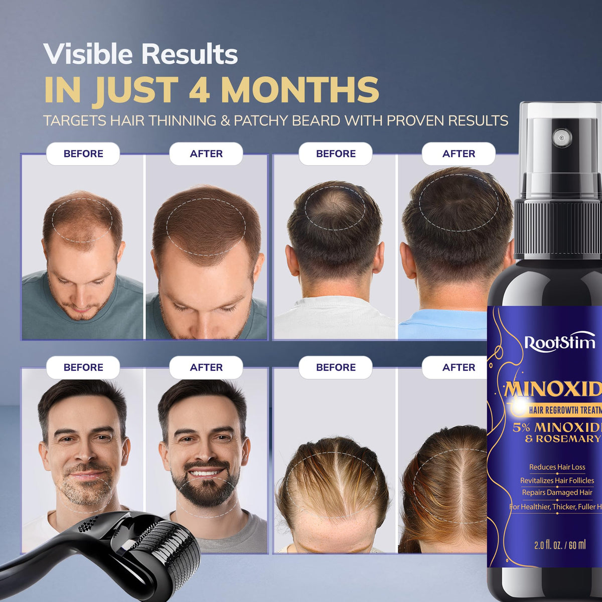 RootStim Hair Regrowth Kit 5% Minoxidil Spray bottle close-up