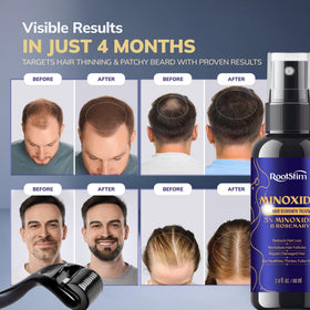 RootStim Hair Regrowth Kit 5% Minoxidil Spray bottle close-up