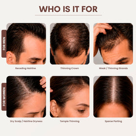 SØREN Micro Infusion Hair Renewal System in use on a scalp