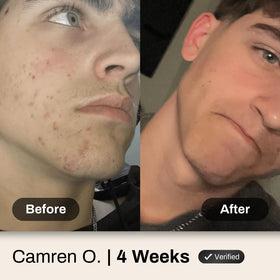 Shield Face Acne Wash for Men with other skincare products