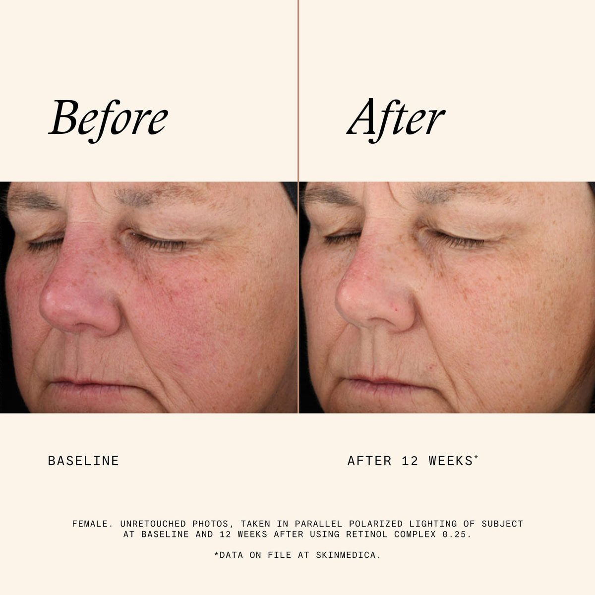 SkinMedica Retinol Serum 0.25 Complex application on skin