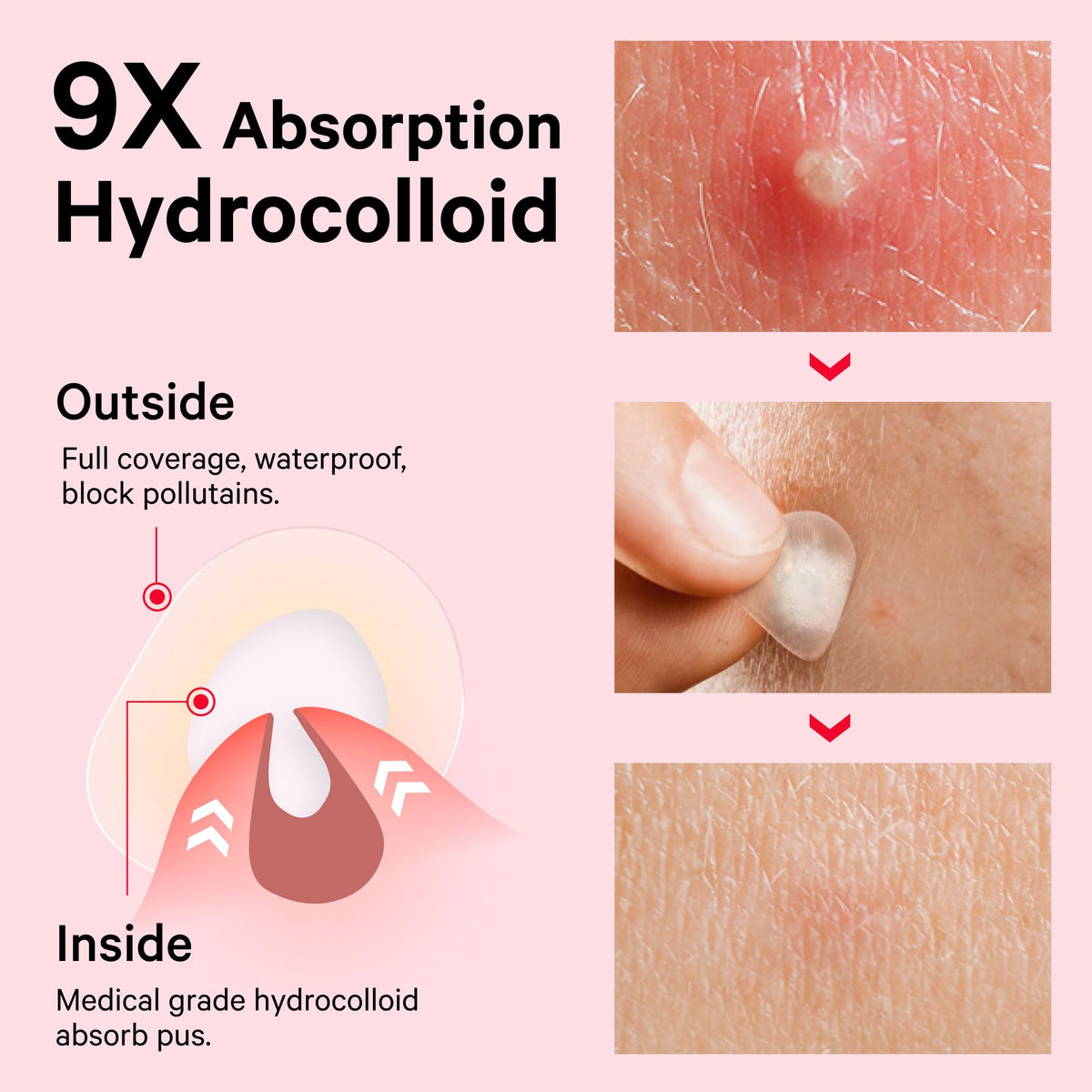 Sosky Pimple Patch applied on skin