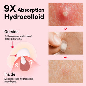 Sosky Pimple Patch applied on skin