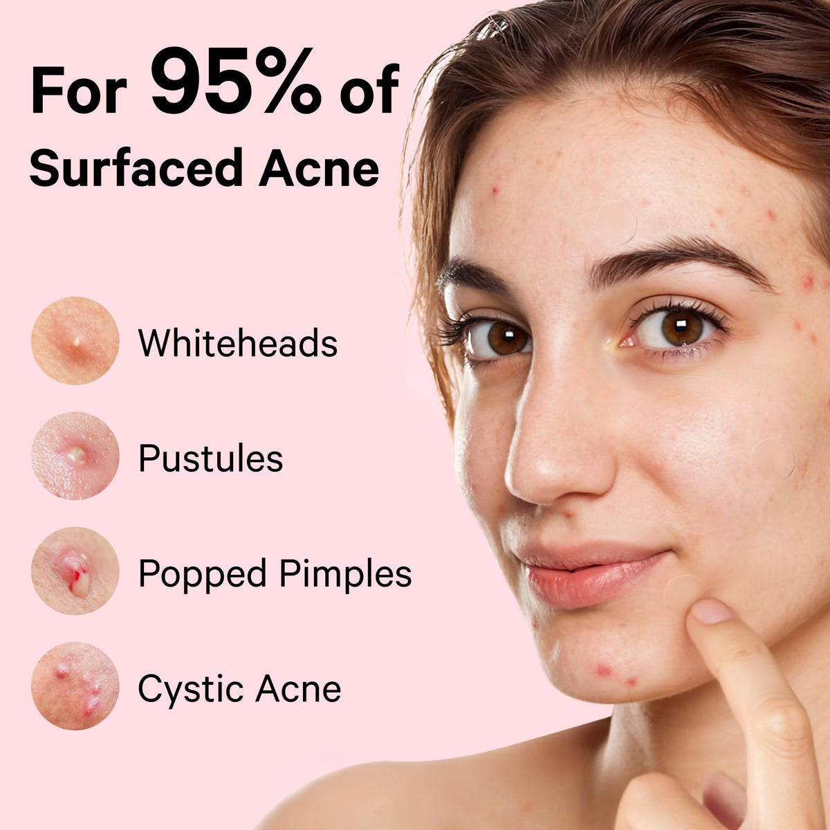 Sosky Pimple Patch showing invisibility on skin
