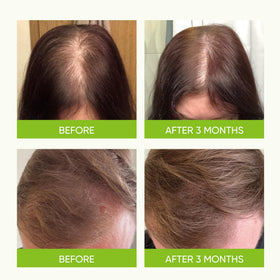 Svvimer Hair Growth Serum Spray application on scalp