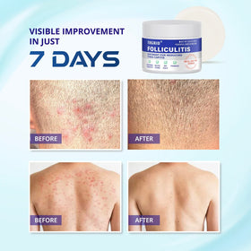 TAGRID Folliculitis Cream application on skin