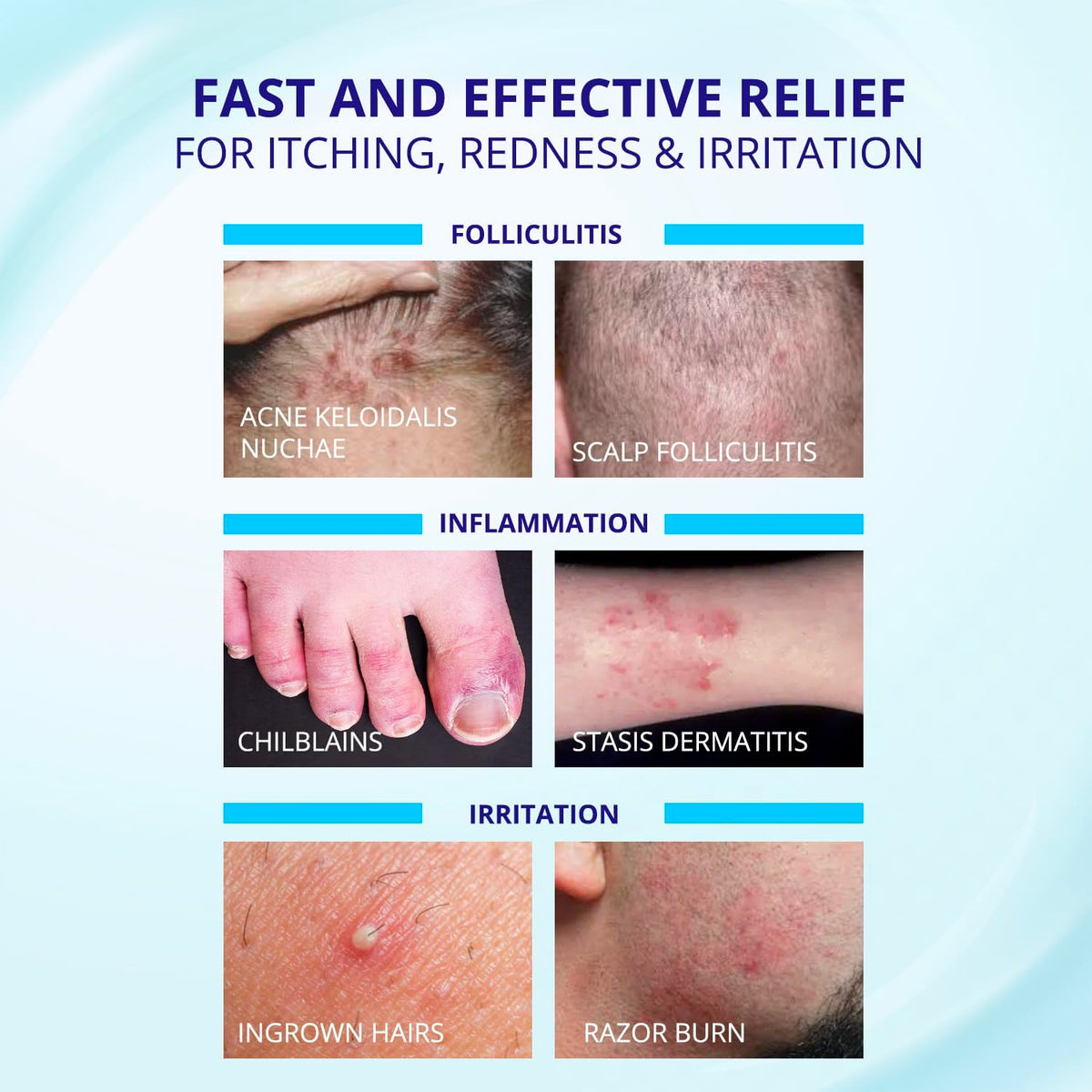 TAGRID Folliculitis Cream ingredients list