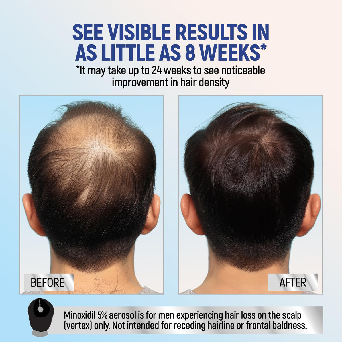 TARO Minoxidil 5% Foam application on scalp