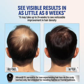 TARO Minoxidil 5% Foam application on scalp