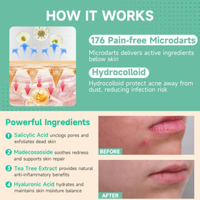 TEAWOO Microdart Acne Patch translucent design on skin