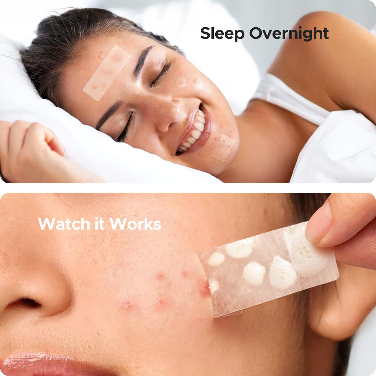 TKTK Large Pimple Patches applied on skin