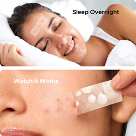 TKTK Large Pimple Patches applied on skin