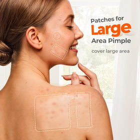 TKTK Large Pimple Patches XL hydrocolloid patches close-up