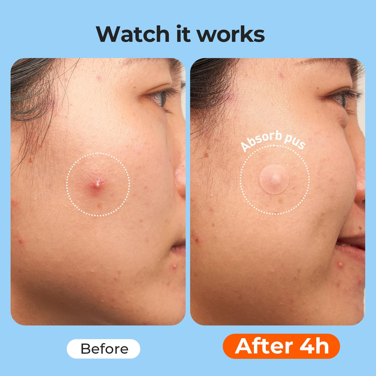 TKTK Pimple Patches variety pack display