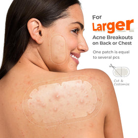 TKTK XXL Pimple Patch applied on skin