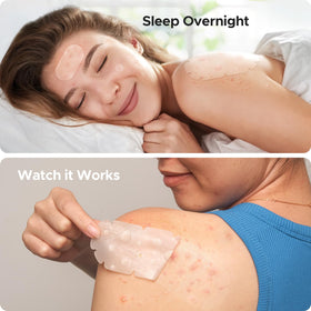 TKTK XXL Pimple Patches in use on back