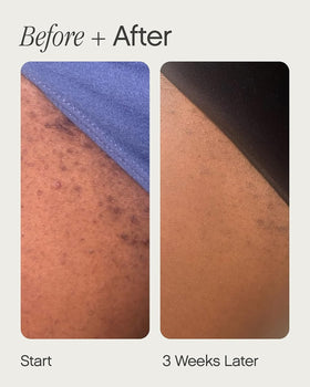 Topicals High Roller Ingrown Hair Serum application on skin