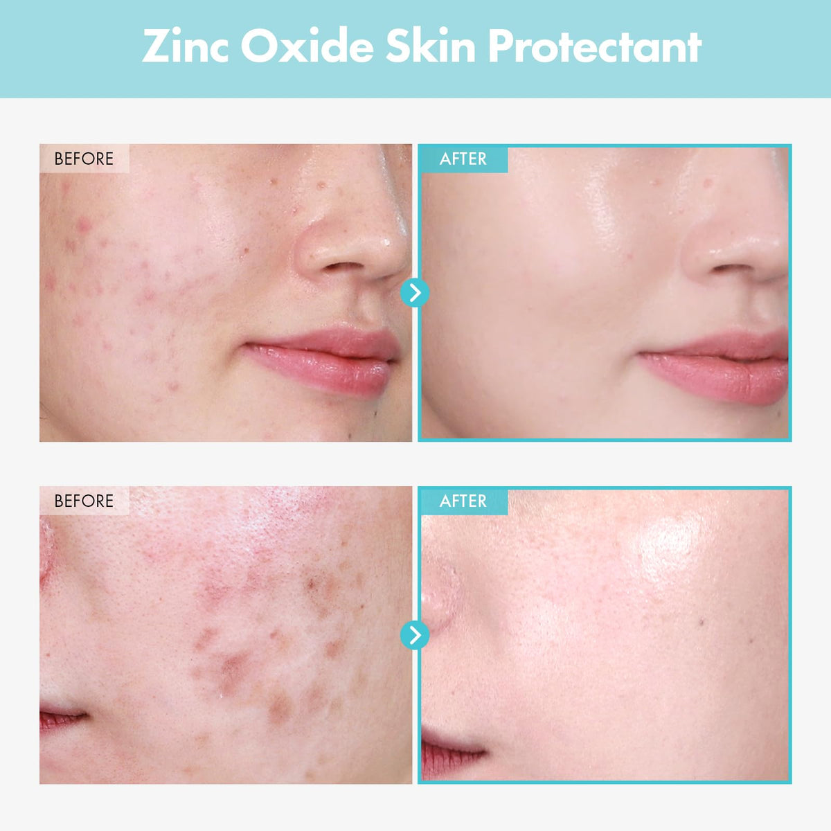 TOSOWOONG Zinc Oxide 10% Cream application on skin