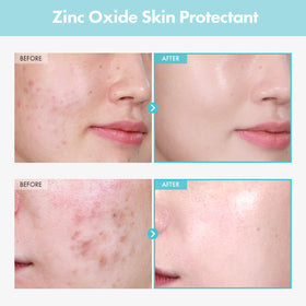 TOSOWOONG Zinc Oxide 10% Cream application on skin