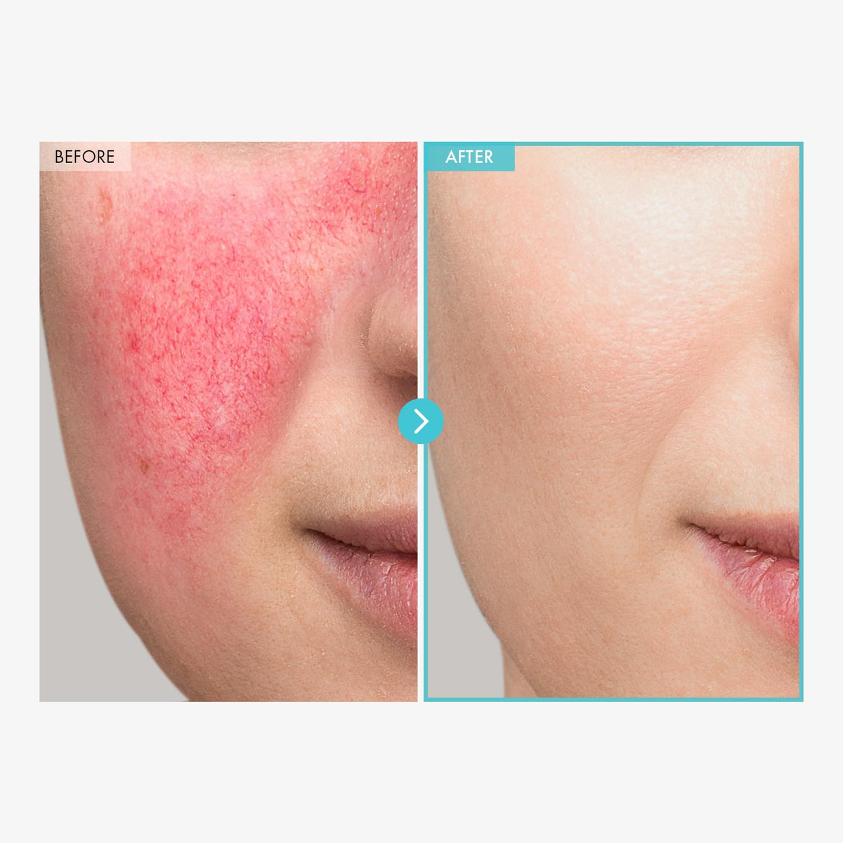 TOSOWOONG Zinc Oxide 10% Cream side view