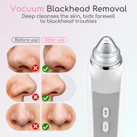 TTozka Blackhead Remover Vacuum with LED lights on