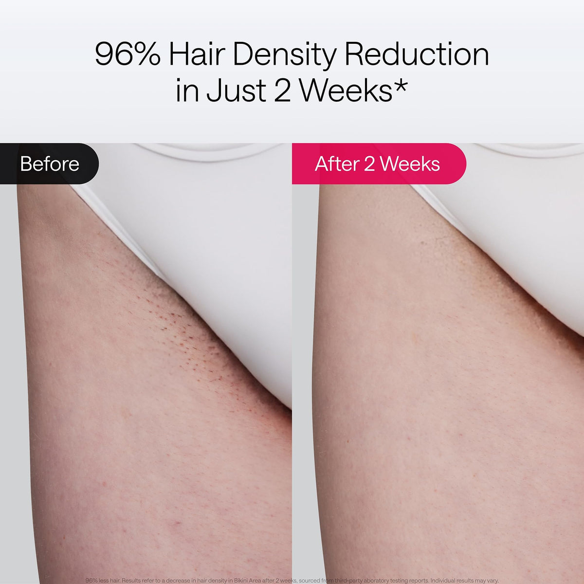 Ulike Laser Hair Removal Air 10 Deluxe showing dual lights and controls