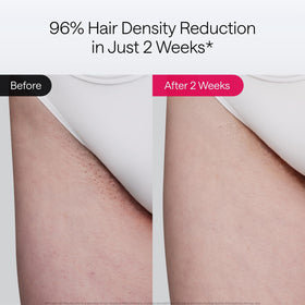 Ulike Laser Hair Removal Air 10 Deluxe showing dual lights and controls