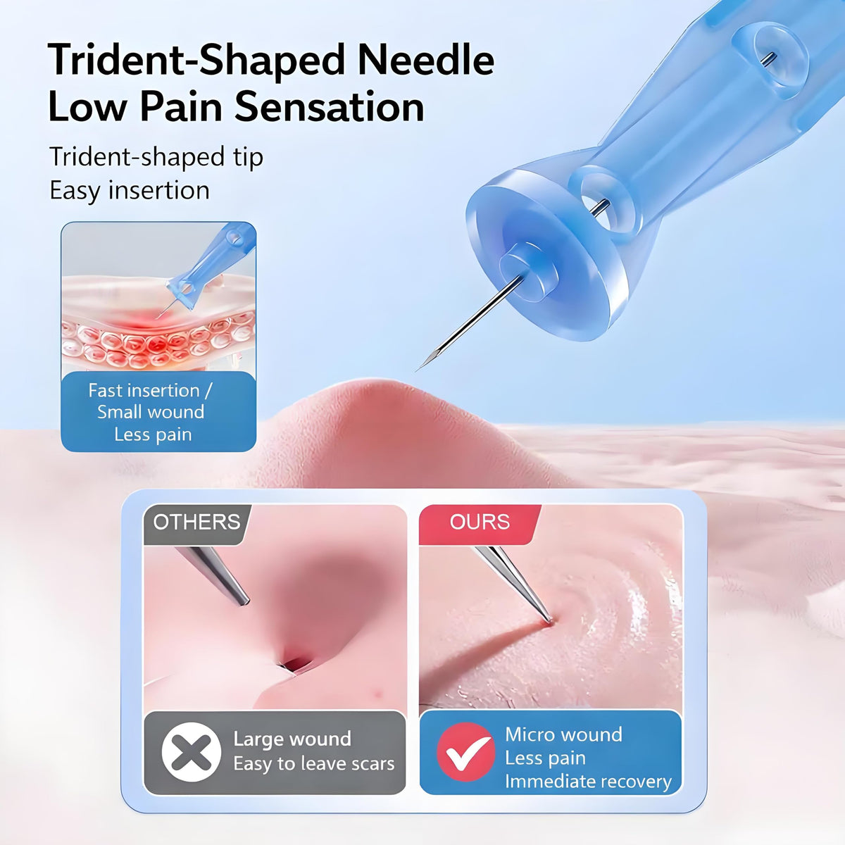 User-friendly blackhead removal tools from UWOIST