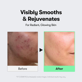 VT COSMETICS CICA Reedle Shot 300 Microneedling Serum application on skin