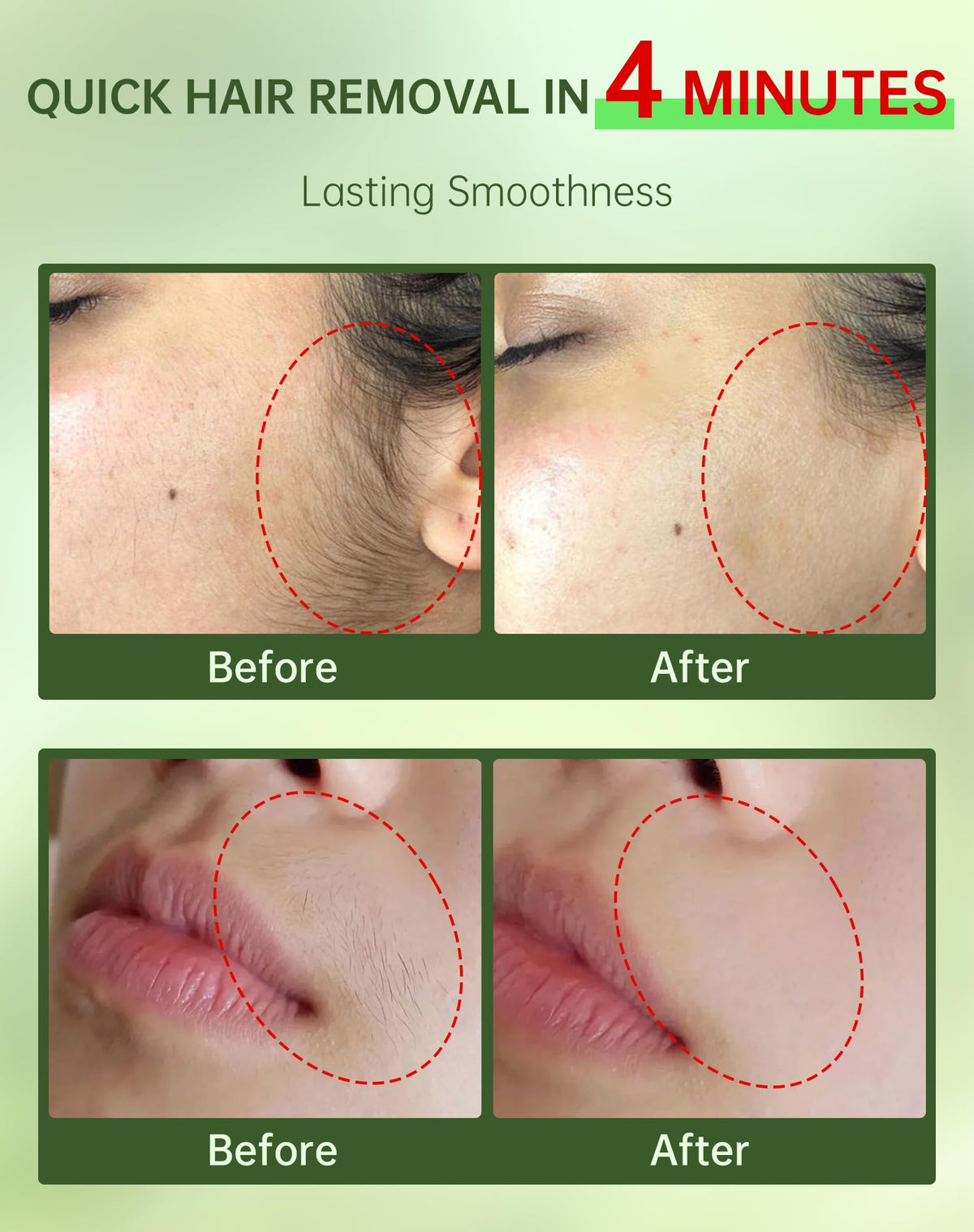 Zeponyx facial hair removal cream application on upper lip