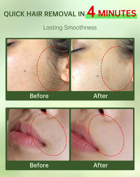 Zeponyx facial hair removal cream application on upper lip